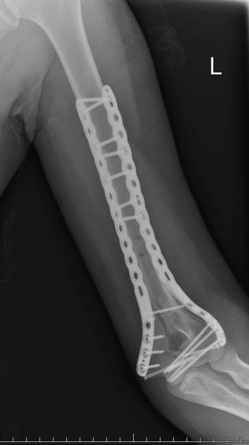 Bioresorbable-implant-after-e1715331710721